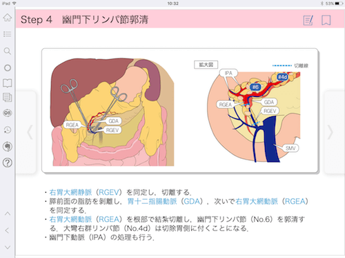 手術NAVI_胃癌サンプル